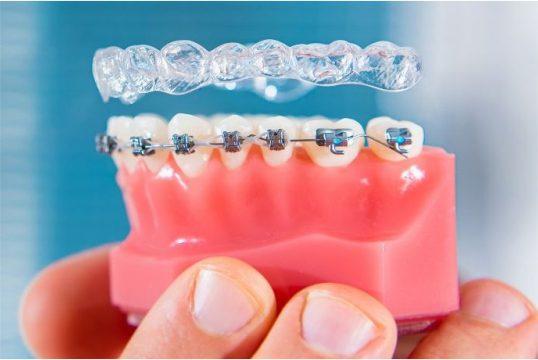 Dental Braces: What They are and How they Work